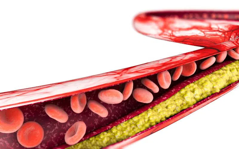 3 Conditions That Raise Triglycerides And Can Cause Stroke Discover